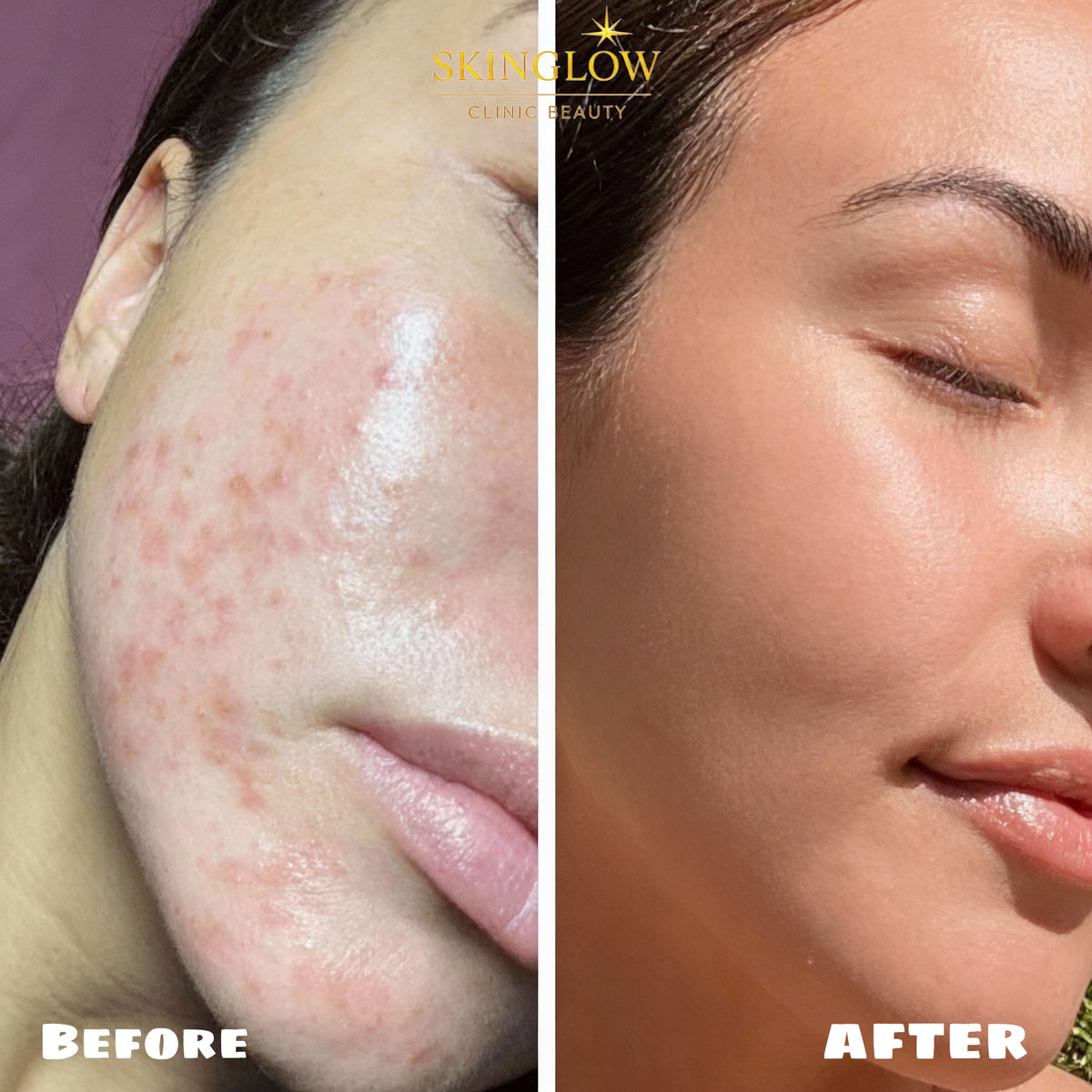 Résultats avant et après traitement