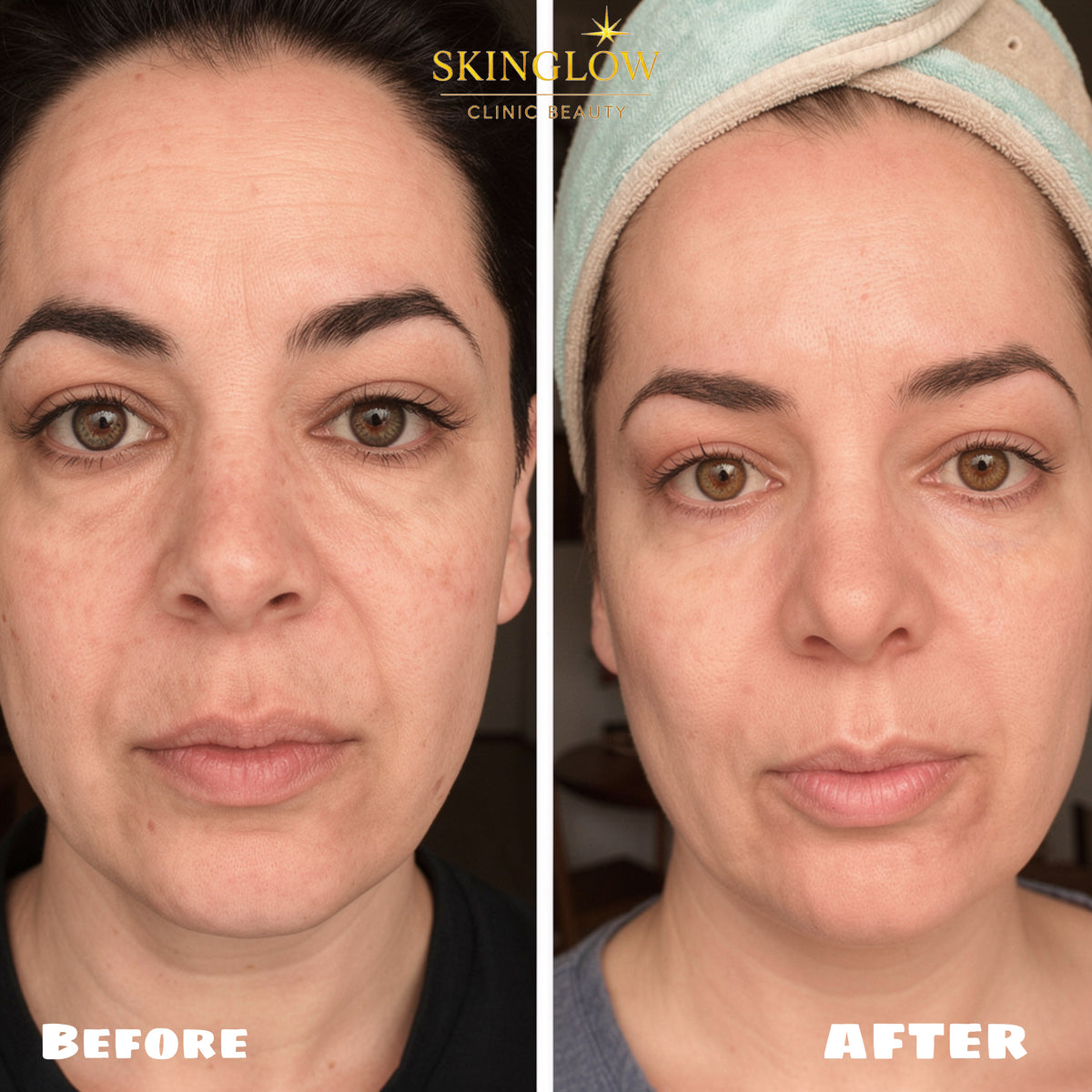 Résultats avant et après traitement